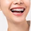 Ortodontia la copii – la ce varsta sa incepi tratamentul?